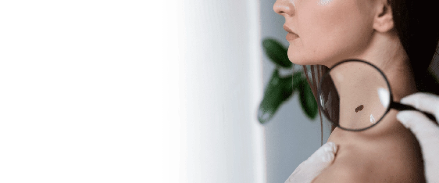 Cкидка 30% на удаление новообразований